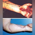 Research heralds ‘step change’ in water jet injury care water-jet-injury-care-changes